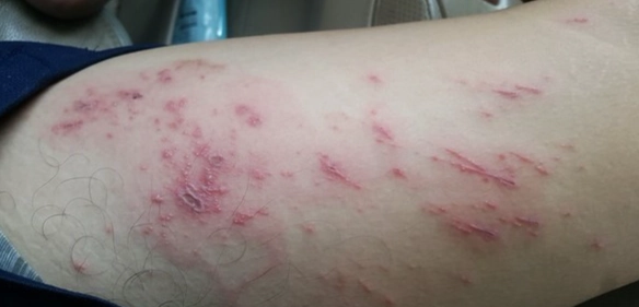 隱翅蟲傷口症狀