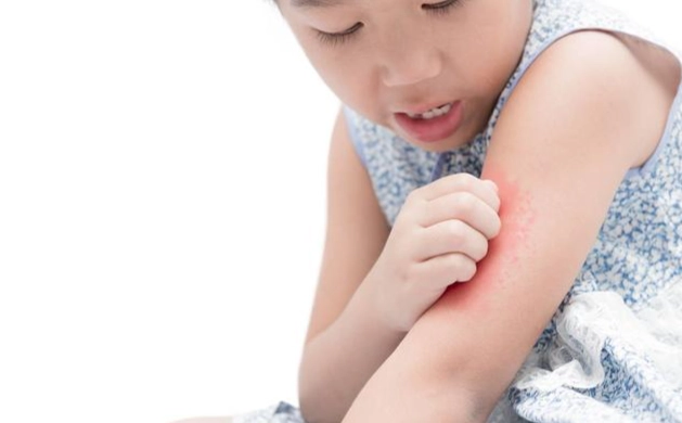被蟲咬刺痛怎麼辦 被蟲咬刺痛怎麼辦